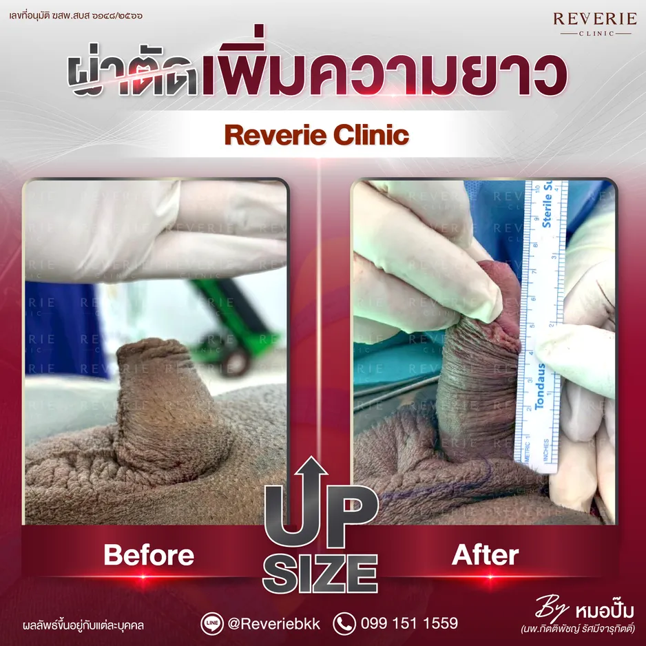 ผ่าตัดเพิ่มความยาว-02