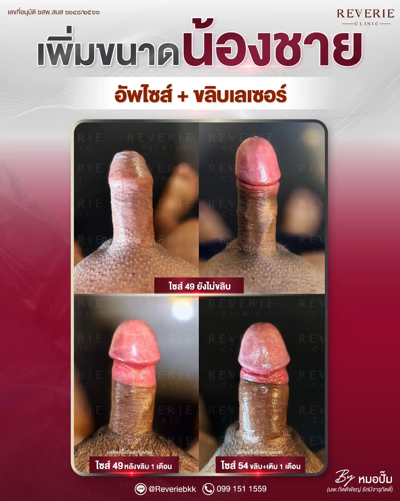 ขลิบและเพิ่มขนาดน้องชาย 1