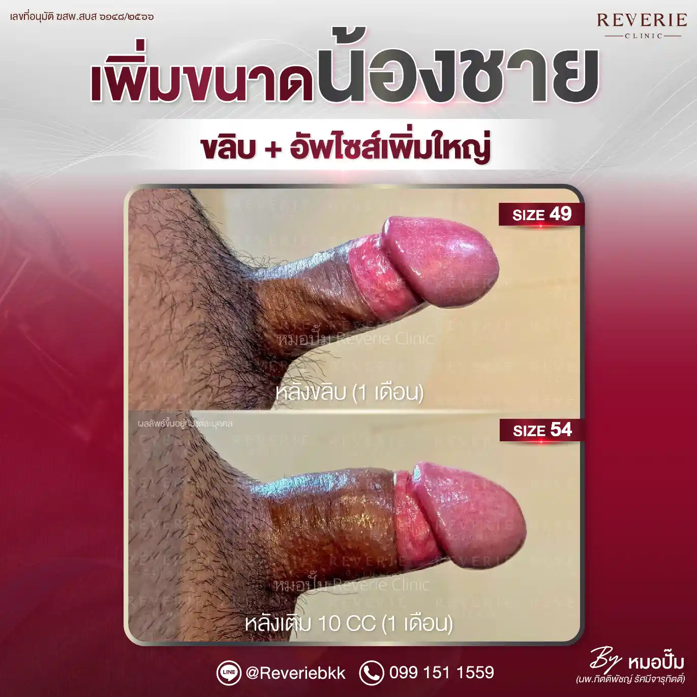 ขลิบและเพิ่มขนาดน้องชาย 2